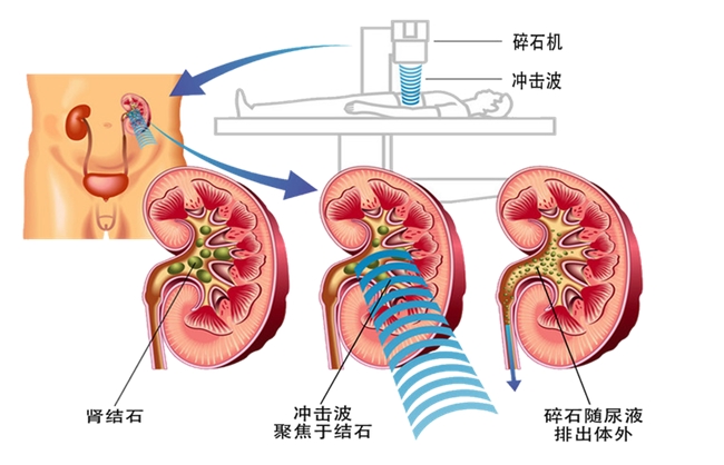 四川碎石医院案例分享：多次碎石“没搞事” 独肾患者保肾取石喜获成功