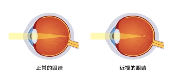 爱尔眼科科普：近视手术后，运动到底行不行？