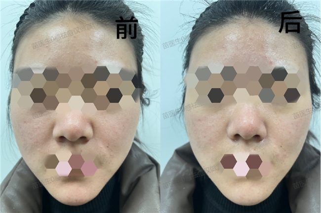 苗医生草本科技祛痘产品升级，再创新高