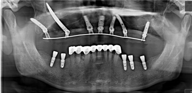 鼎植刘昭院长要把“即刻有牙”的快乐，从深圳福田推广到大湾区