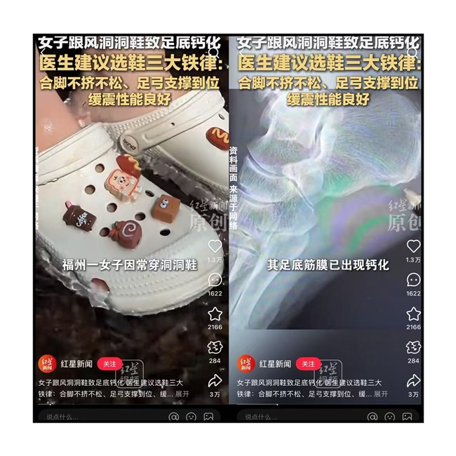 “一时爽”毁掉健康！女子穿洞洞鞋的教训，选电视时千万别再犯！