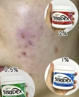 把“油痘肌”的自卑留在这个暑假