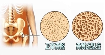 给爸妈天天补钙还是骨质疏松？你可能踩了这些'隐形坑'！